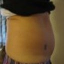 Before smart lipo - side